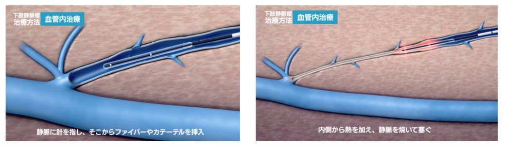 下肢静脈瘤治療方法　血管内治療